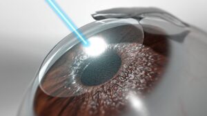 Read more about the article Tips to guide you after your laser eye surgery